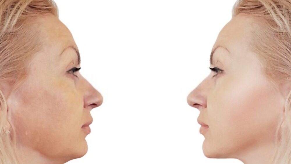 5-point facelift